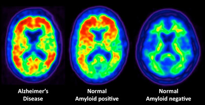 British scientists have developed a PET scan to search for early signs of Alzheimer’s disease.